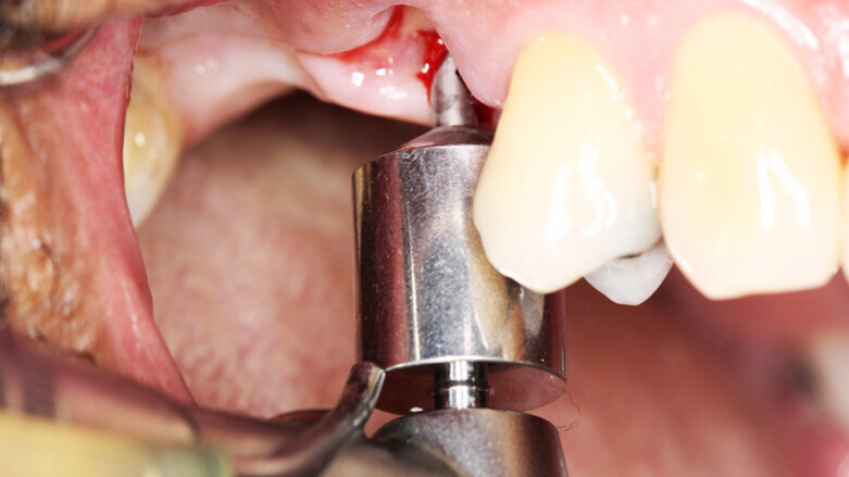 Dva v jednom: Pilotní vrták a chirurgická šablona