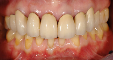 New paradigm in aesthetic restoration