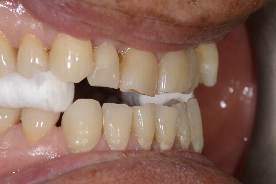 Figs. 14a–c: New approximate centric position determined with cotton rolls and the tongue on the palate.