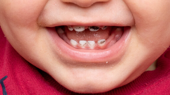 Silver diamine fluoride can arrest severe early childhood caries