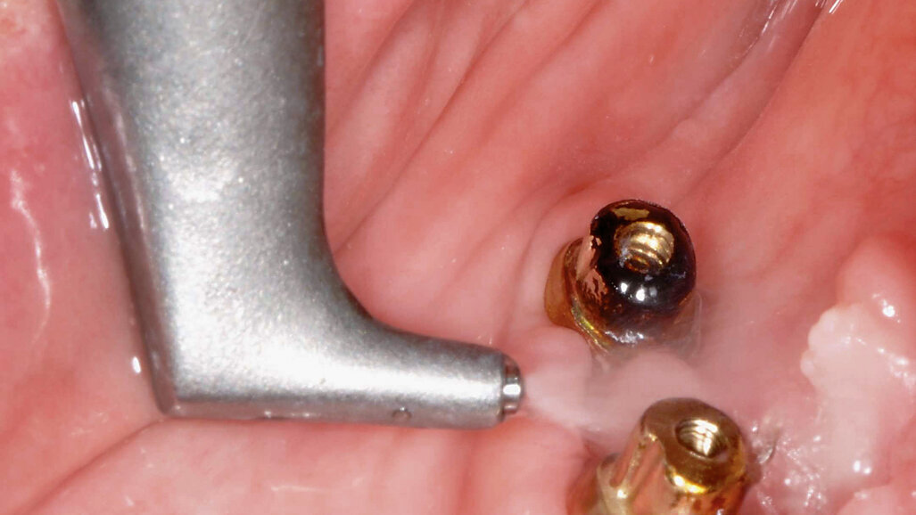 De la complicațiile implantelor la renaștarea lor.