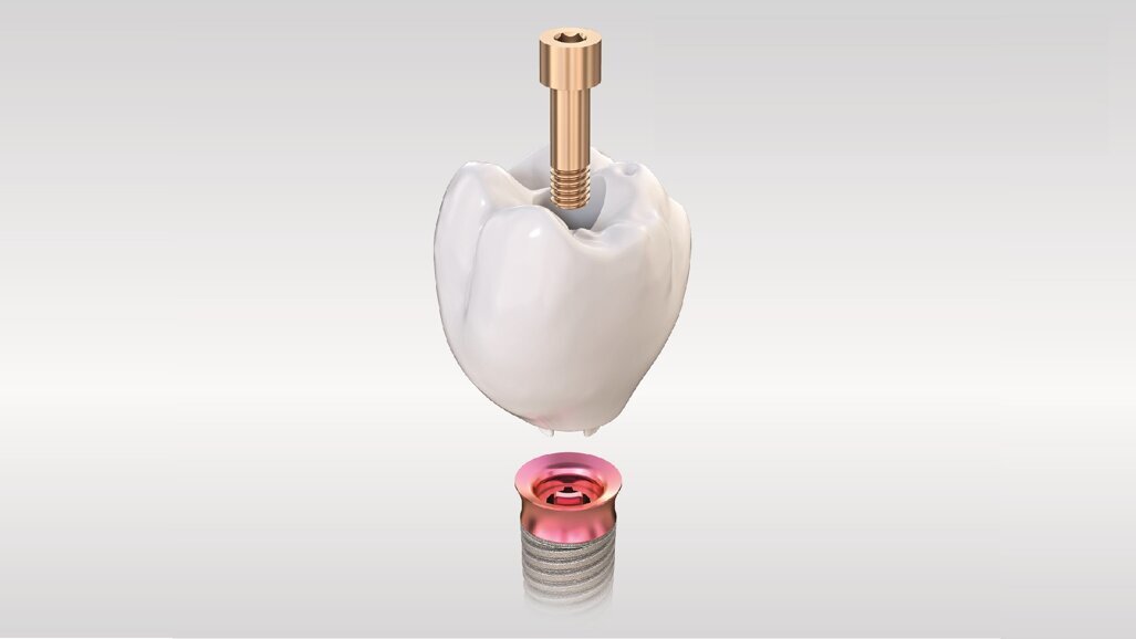Kooperation von TRI Dental Implants und Amann Girrbach: Implantate ohne Abutment im vollstädig validierten Workflow