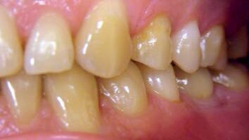 Interdyscyplinarne podejście do leczenia implantoprotetycznego