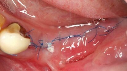Nici chirurgiczne – typy i zastosowanie w chirurgii jamy ustnej