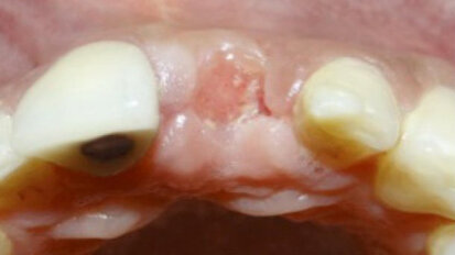 Preservación alveolar