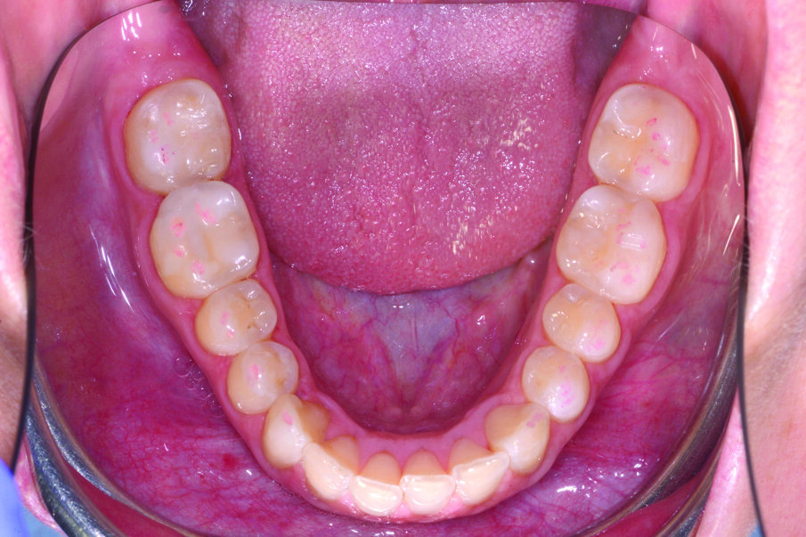 Fig. 10_Caso finale dopo aver eseguito i restauri ultraconservativi.