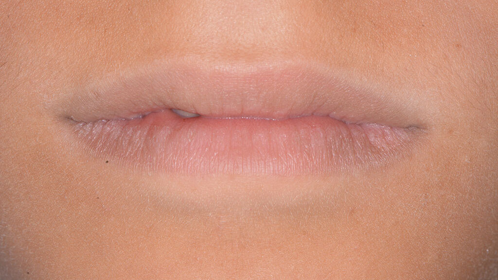 La terapia di mantenimento e l’approccio clinico D-BIOTECH: case report