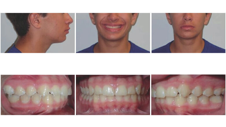 The current Invisalign product is now configured for 1-week aligner changes. At the time of treatment, the aligners were changed every two weeks. 