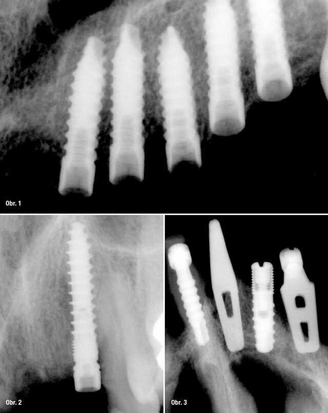 Implantáty UIS Implandenta in situ