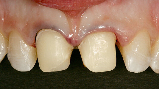 Inovativní postup adhezivního upevňování