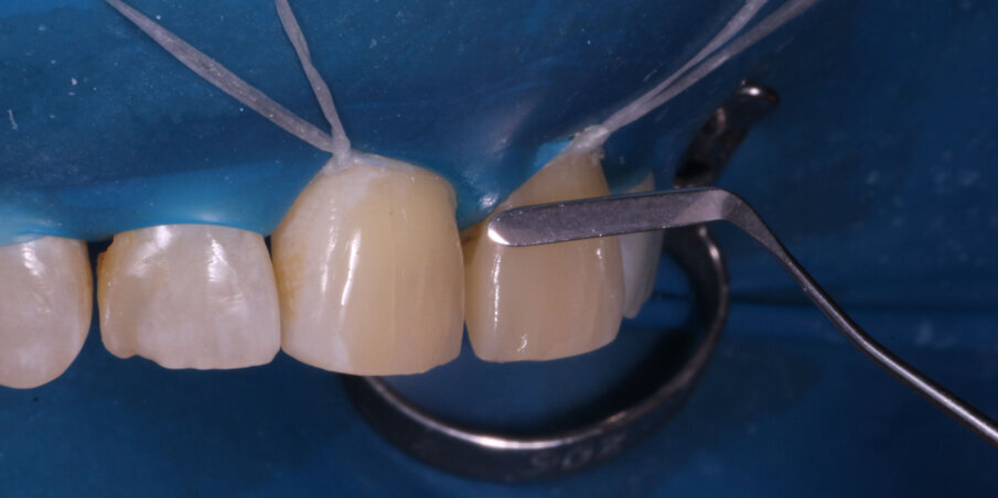 Fig 5. A thin bladed spatula is used to contour the critical cervical region