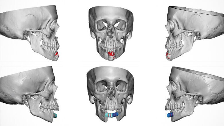 Jaw-in-a-day surgery successfully performed for the first time in Alabama