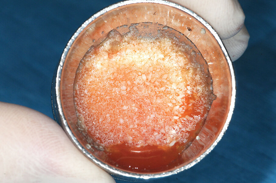 Fig. 14: The plasma wets and rehydrates the allograft particles and is allowed to sit for 10 to 12  minutes before use.