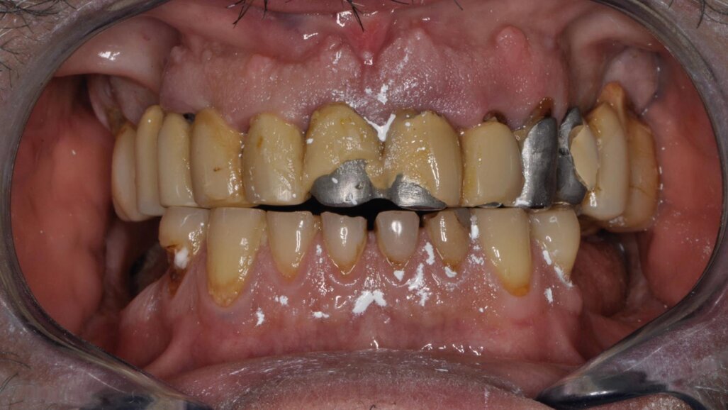 Riabilitazione del sestante mandibolare anteriore con restauri in composito ibrido stampati in 3D alla poltrona: follow-up a 7 anni