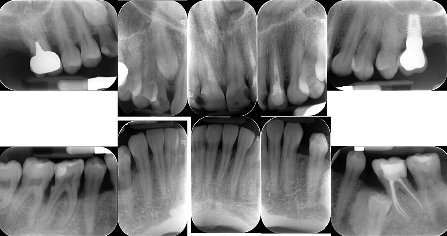 Fig. 3 - Status radiografico al T0.