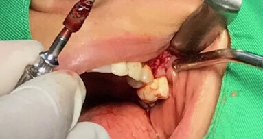 Explantace a okamžitá implantace kombinací reverzního krouticího momentu a trepanační frézy