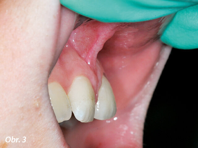 Iniciální situace ukazující diastema.