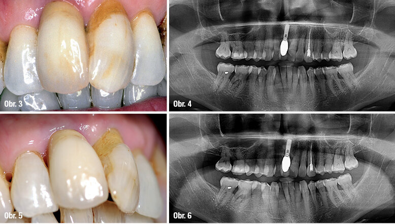 Vhojený implantát / OPG 1999 / Kontrola 2016 / OPG 2016