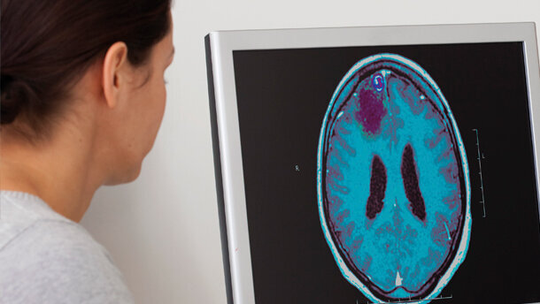 L’epilessia nel bambino: aspetti odontoiatrici e ortodontici