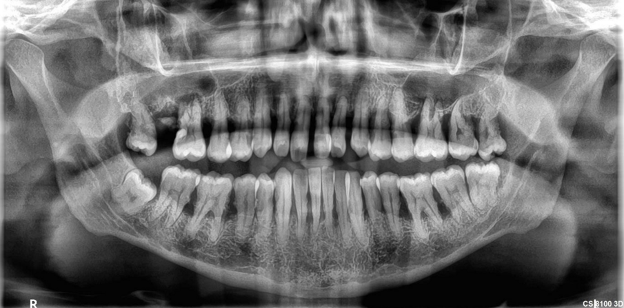 Fig. 2b: Same patient in 2023 with severe deterioration of previous condition and no follow up or SPT.