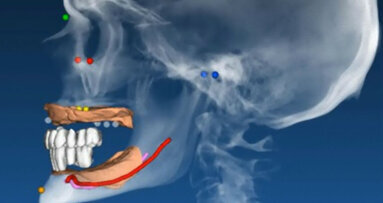 Quattro punti da non dimenticare nella programmazione implantare