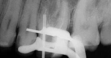 Retrait d’un instrument fracturé : nouvelle approche