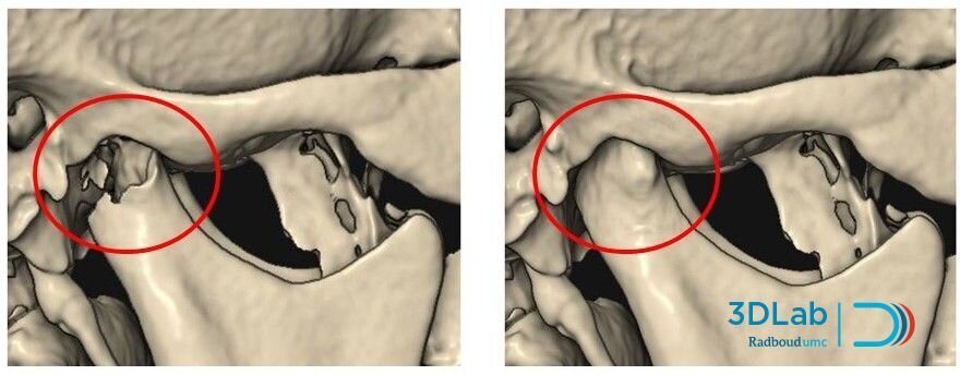Afbeelding 2. Een AI-algoritme waarmee de kaakkopjes heel snel, nauwkeurig en volledig automatisch (dus zonder tussenkomst van een medisch specialist) gevisualiseerd en geïnspecteerd kunnen worden.