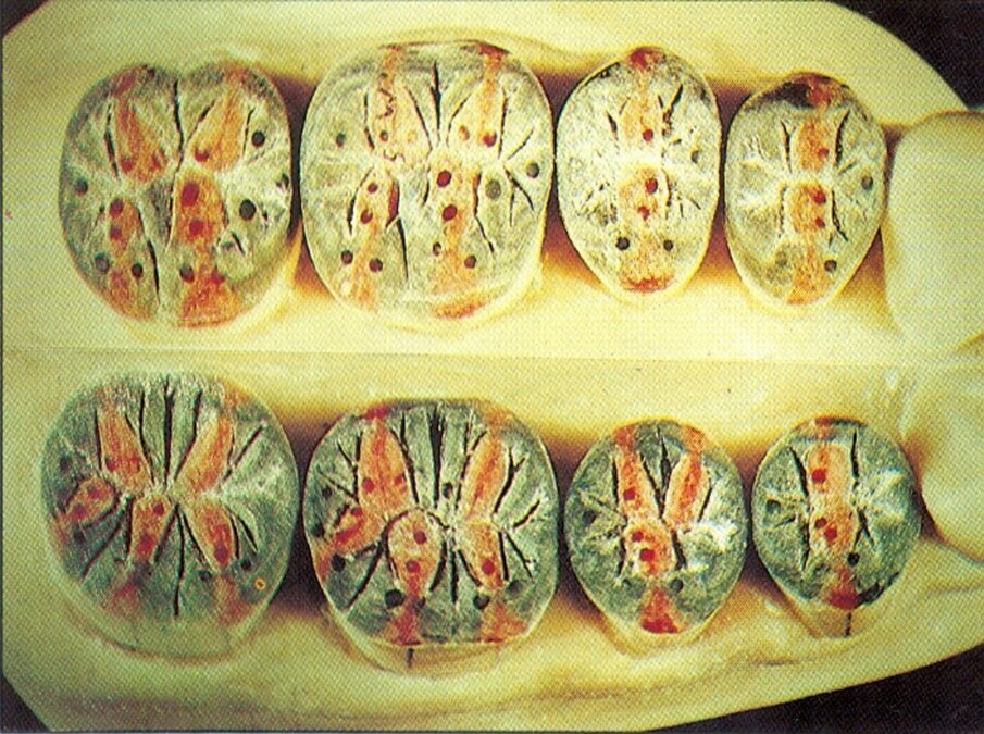 Fig. 1 - Modellazione didattica in cera a totale tripodizzazione di Peter K. Thomas 168 punti di contatto.