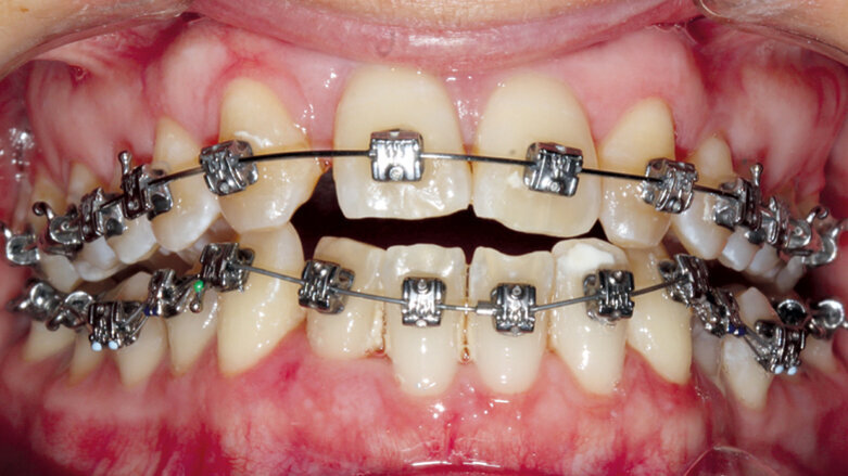 Nechirurgická léčba anomálií III. třídy s agenezí laterálních řezáků