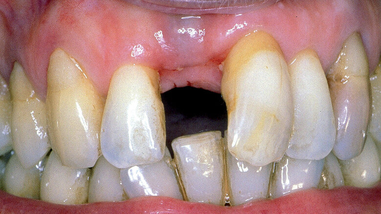Triumfy a tragédie v implantologii