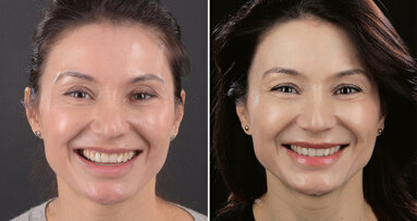 Preoperative digital planning