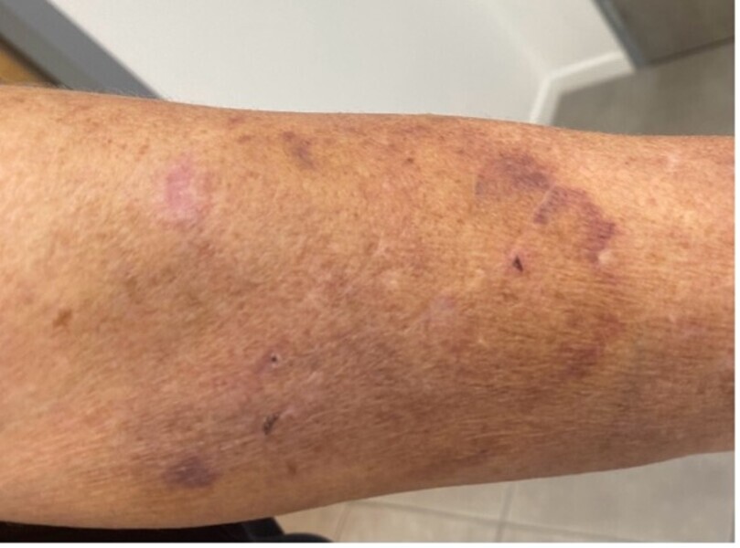 Fig. 8 : Disparition des signes dermatologiques seulement une semaine après le retrait du complexe implanto-prothétique suspect. Il y a dans ce cas une réelle relation de cause à effet entre le complexe implanto-prothétique et les manifestations cutanées.