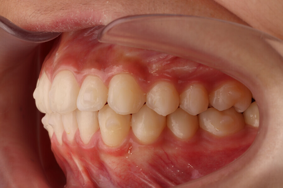 Figs. 21–25: Final clinical situation after finishing treatment. Class I relationship with full intercuspation, anterior alignment, coinciding midlines and rounded arches.