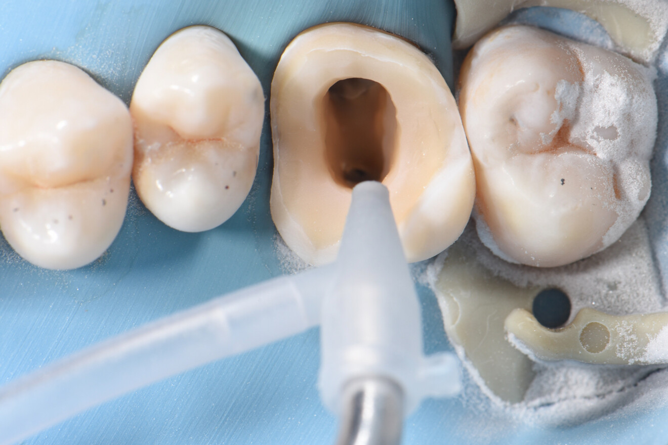 Fig. 13: Air abrasion to clean the enamel margins and smooth the preparation surface.
