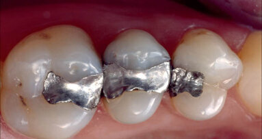 Cementování nepřímých estetických prací