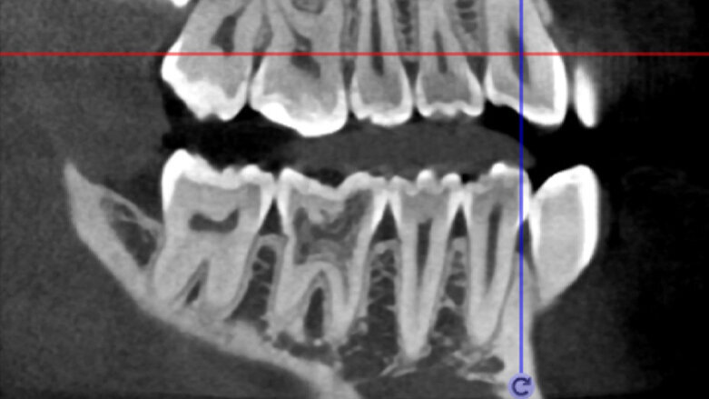3D technologie v diagnostice a léčbě endodontických onemocnění