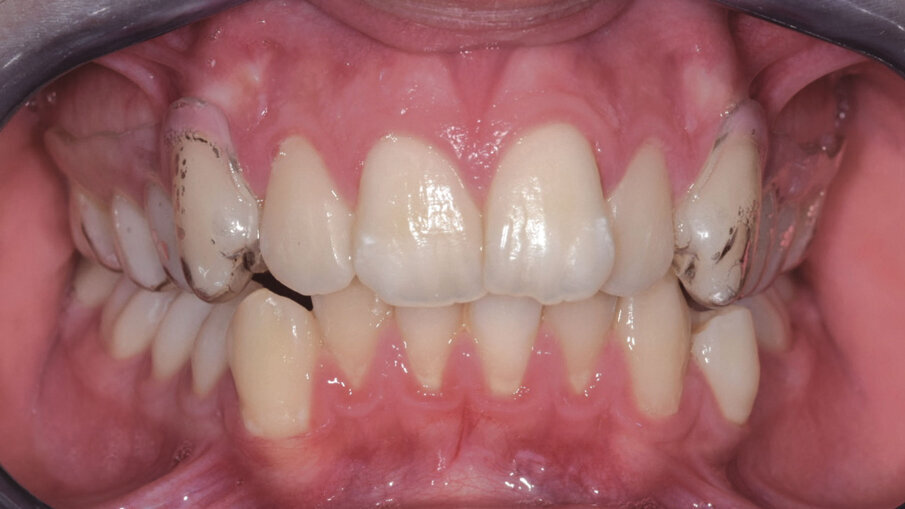 Figg. 2a-2c_Utilizzo del dispositivo ALLEO+ come ausiliare per espandere e ottenere spazio in arcata superiore, al fine di utilizzare, successivamente, un numero di allineatori ridotto e una minore quantità di stripping.