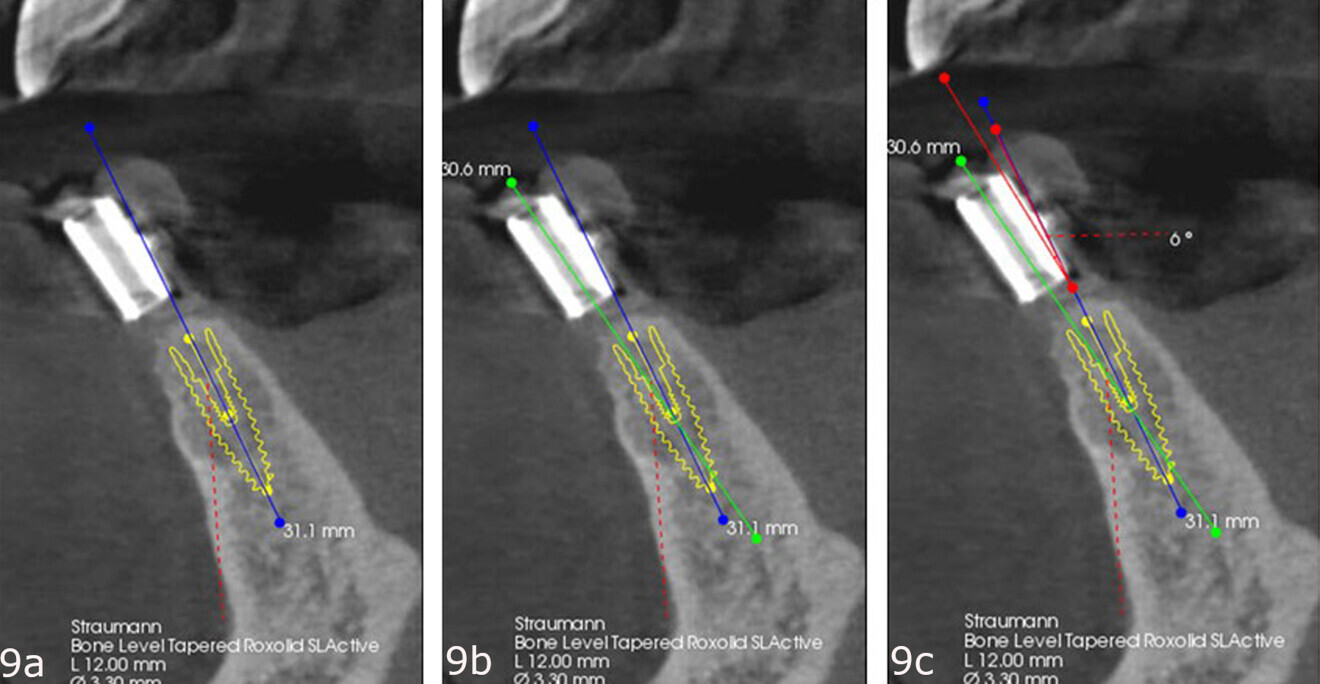 Figs. 9a–c: Long axis of the virtual implant (blue line) drawn in (a). Long axis of the guide sleeve (green line) added (b). Angle correction in the buccolingual dimension (red line) was determined to be 6° (c).