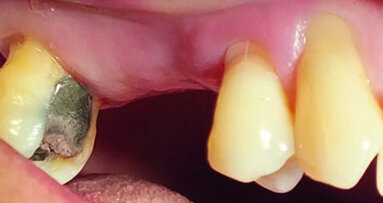 Dynamic navigation for reliable and predictable flapless implant placement Dynamic navigation for reliable and predictable flapless implant placement