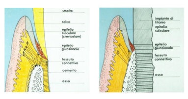 La mucosità perimplantare e la perimplantite: il loro ruolo nella patologia implantare
