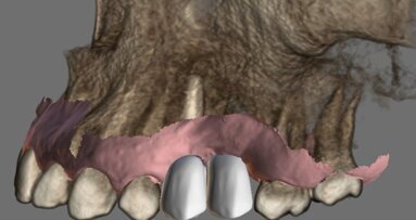 È qui il futuro: implantologia navigata con il Navident