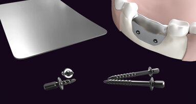 New generation of dental biomaterials launched by botiss