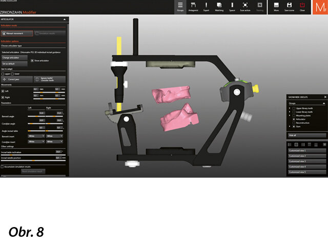 Přenesení situace do virtuálního artikulátoru a umístění jednotlivých rovin (pomocí funkcí „Generic“ a „Plaster“).