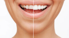 Adhesives influence colour stability of composite veneers