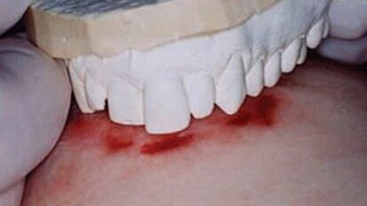 “Bijtafdruk niet meer gebruiken als forensische methode”