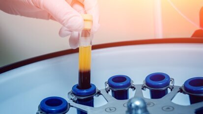 Emocomponenti a uso non trasfusionale (EunT): vantaggi e criticità