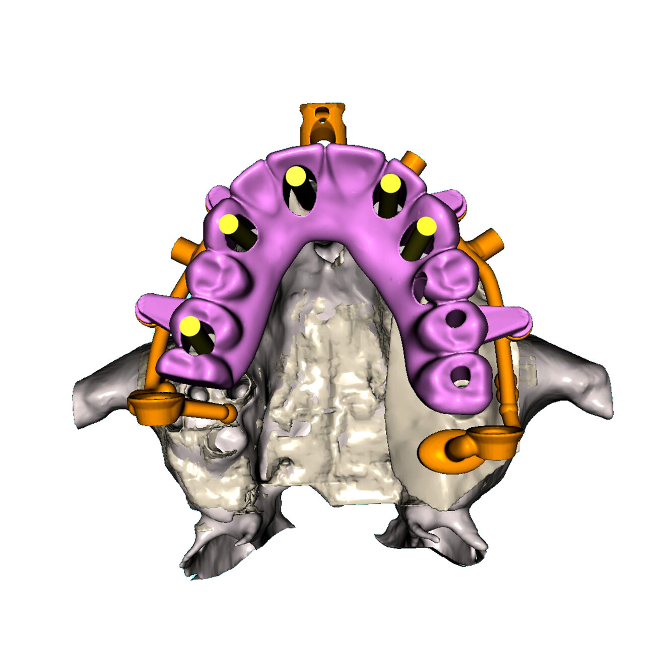 Fig. 15c: Occlusal view showing the simulated titanium cylinders (yellow) emerging through the provisional prosthesis.