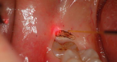 Il laser: perché e quando serve?