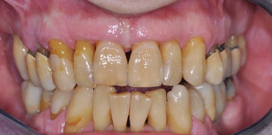 Fig. 1_Foto pre-operatoria di uno dei pazienti inclusi al tempo della chirurgia.