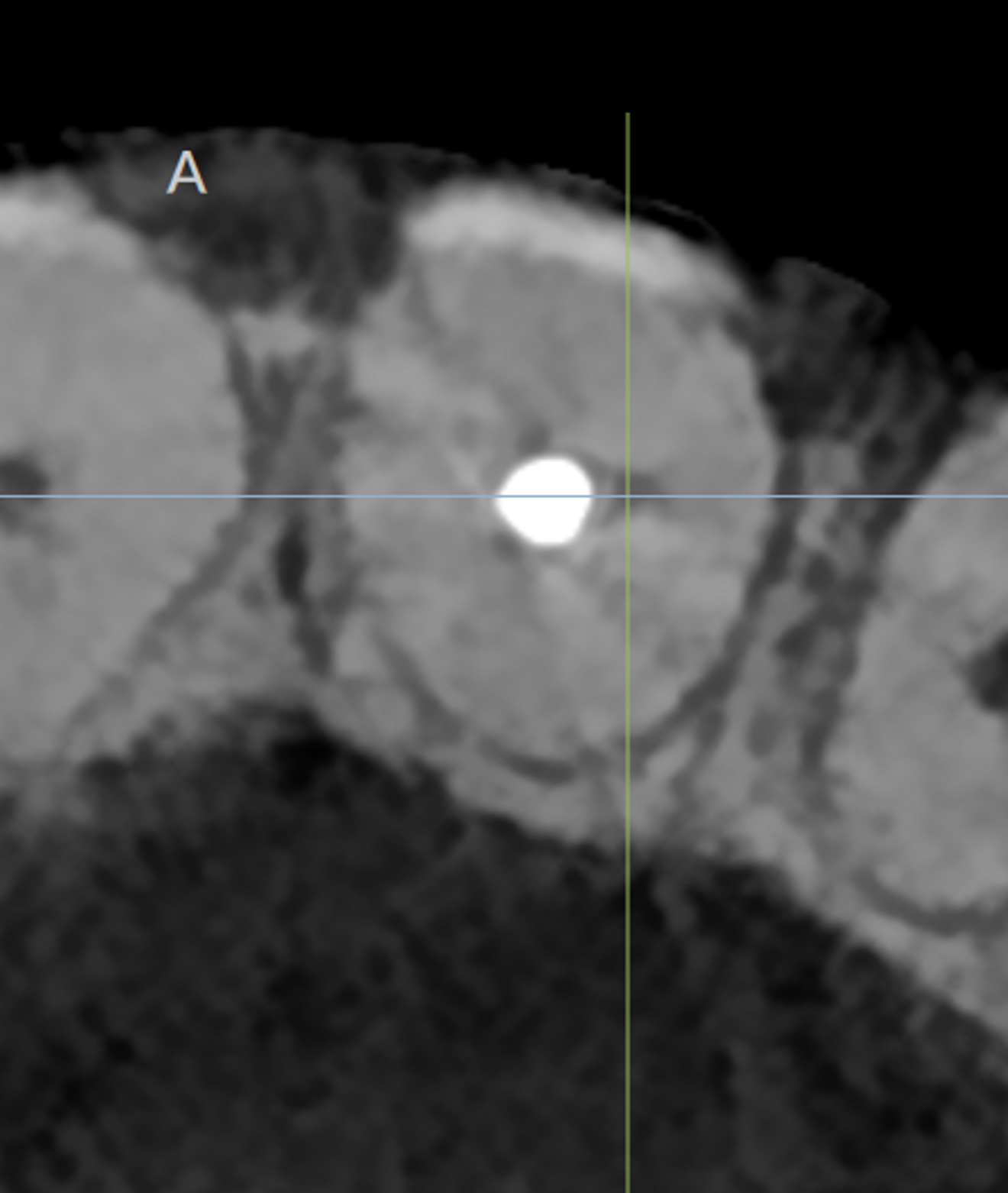 Fig. 2: Location of the furcation.